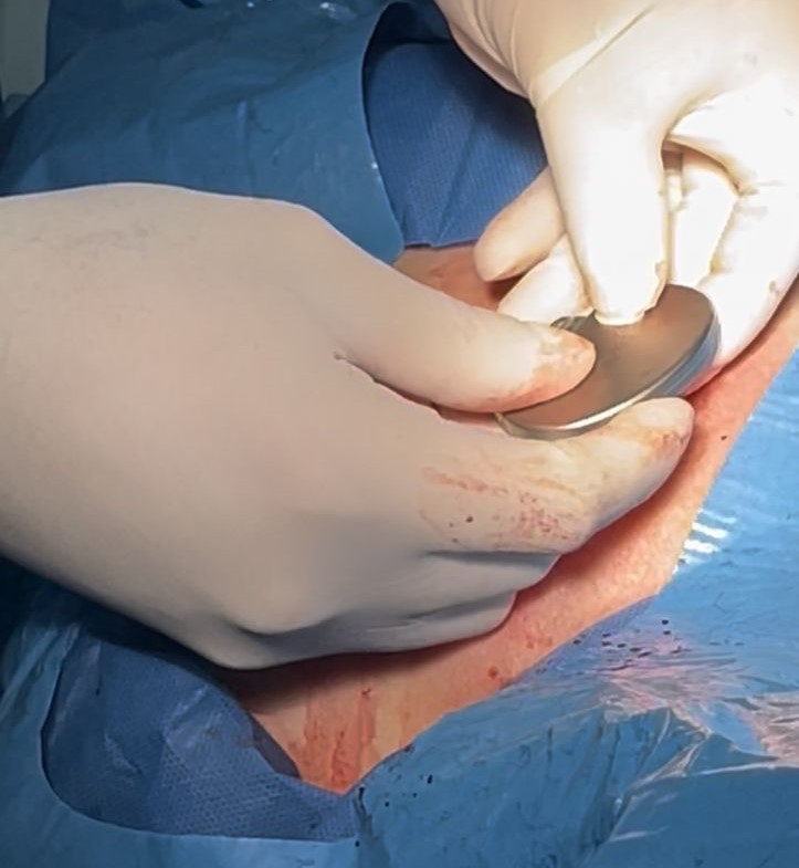 Hospital Universitario de Los Andes inició implantación de marcapasos