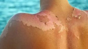 Especialistas llaman a cuidar la piel ante el aumento de las temperaturas