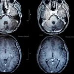 Tumores cerebrales: nueva vacuna ofrece esperanza de vida