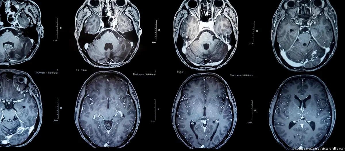 Tumores cerebrales: nueva vacuna ofrece esperanza de vida